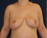 Feel Beautiful - Breast Augmentation Lift 67 - Before Photo